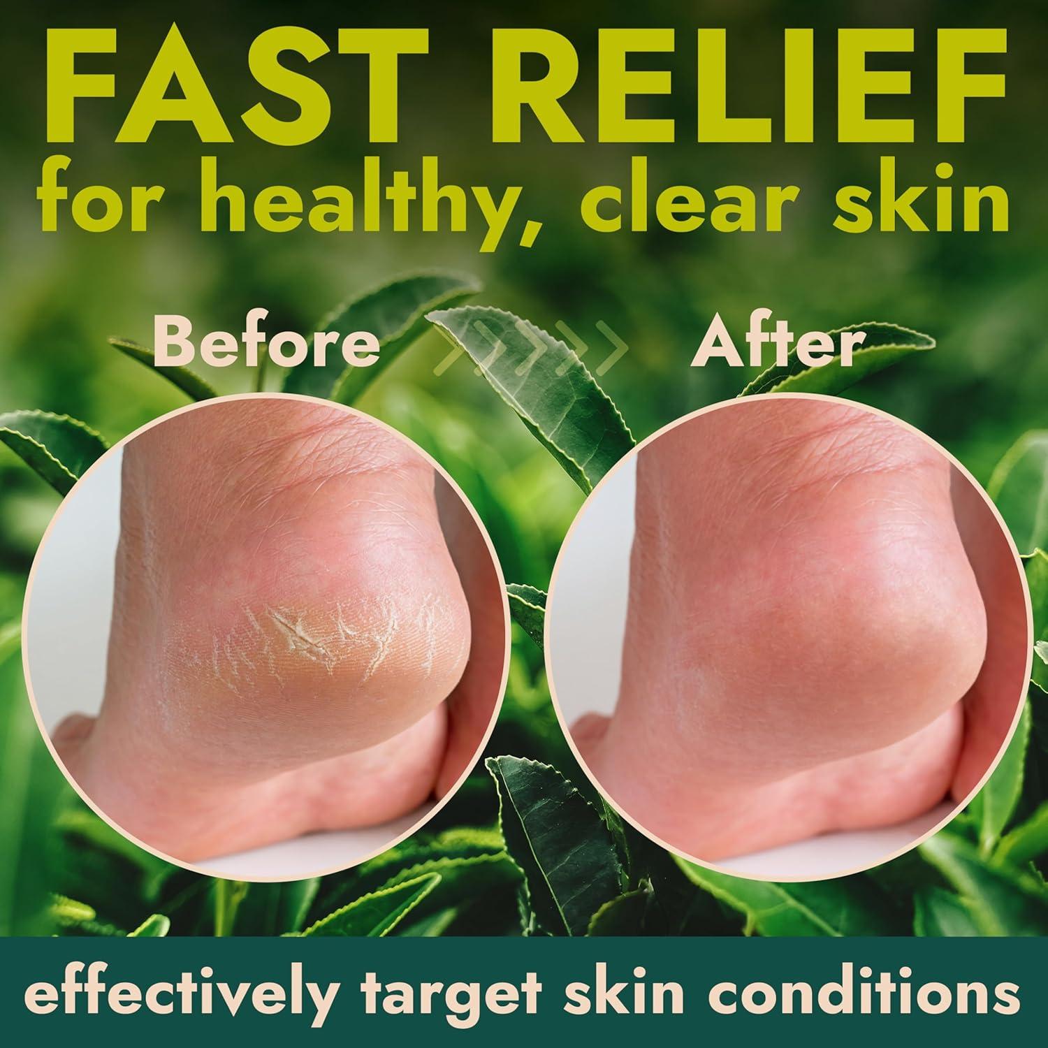 Gel Removedor de Callos 414ml + 3 Piedras Pómez | Árbol de Té