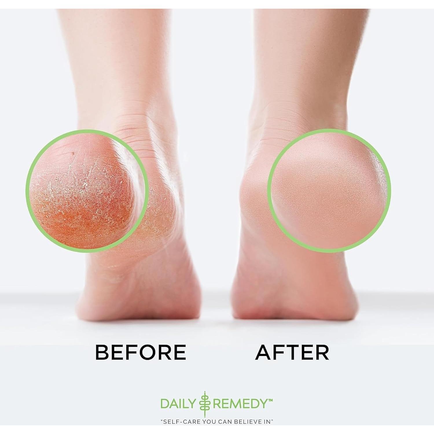 Gel Removedor de Callos Daily Remedy 226.8g - Pies Suaves