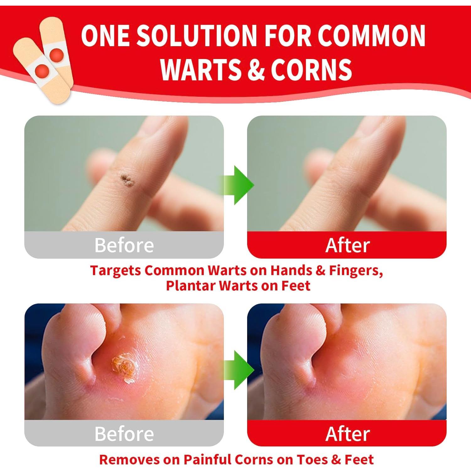 Parche Removedor de Verrugas y Callos DERMFREE 42 Piezas 40% Ácido Salicílico