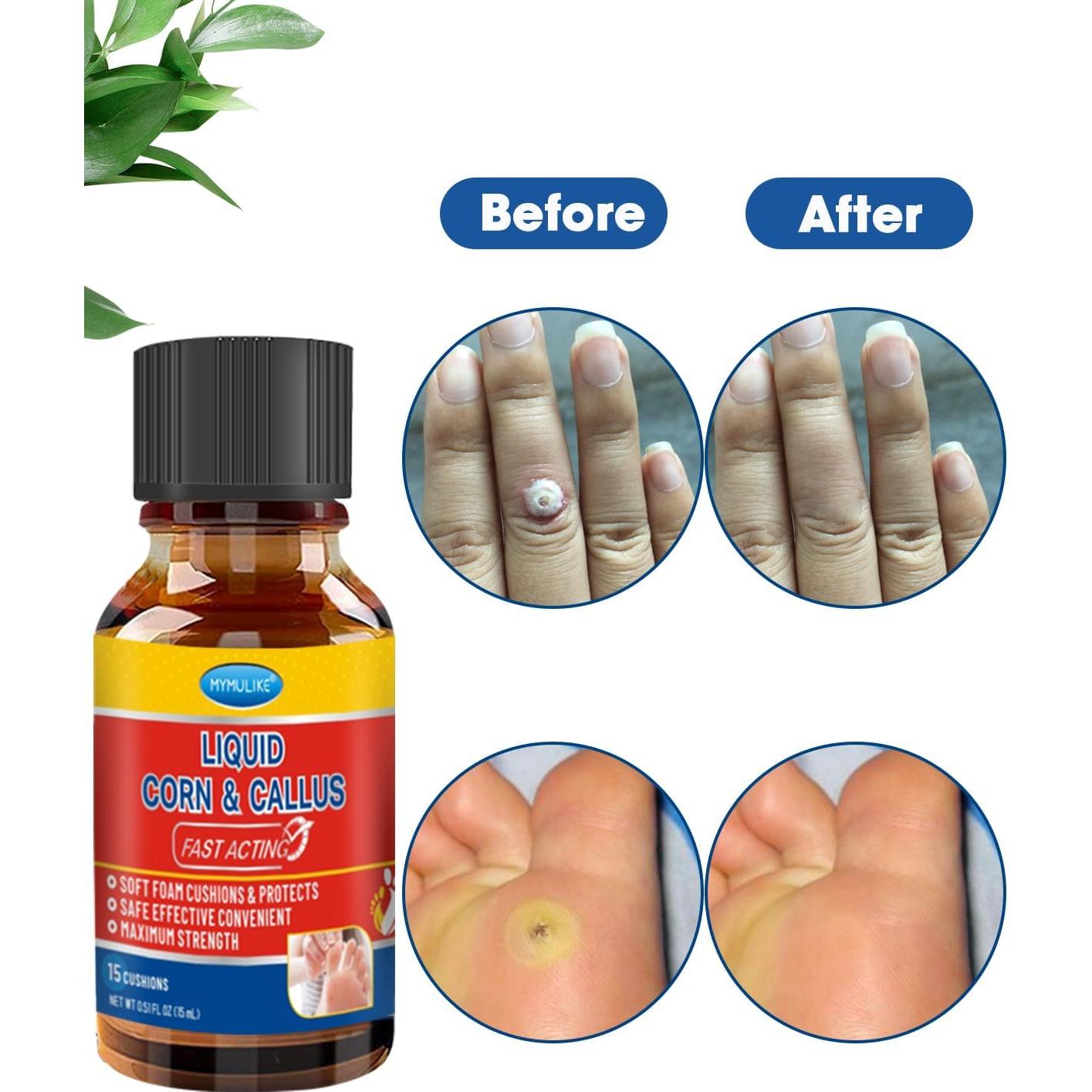 Removedor de Maíz Líquido MYMULIKE 15ml con Aplicadores