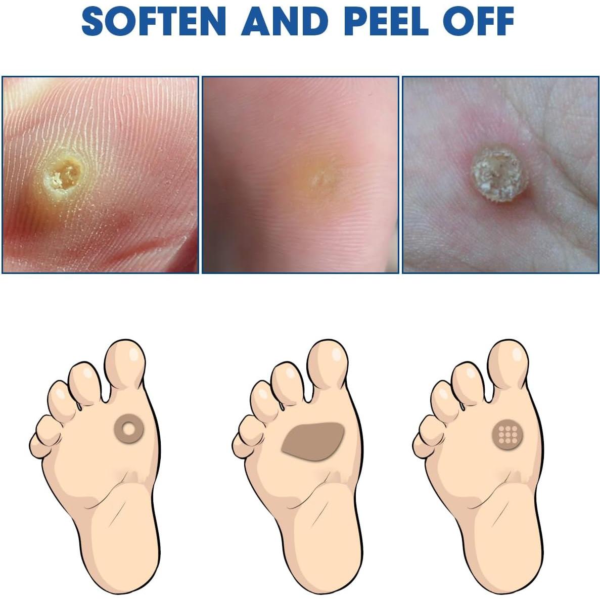 Removedor de Maíz Líquido MYMULIKE 15ml con Aplicadores