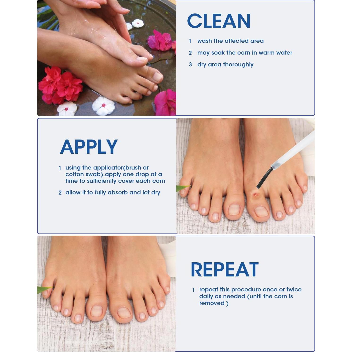 Removedor de Maíz Líquido MYMULIKE 15ml con Aplicadores