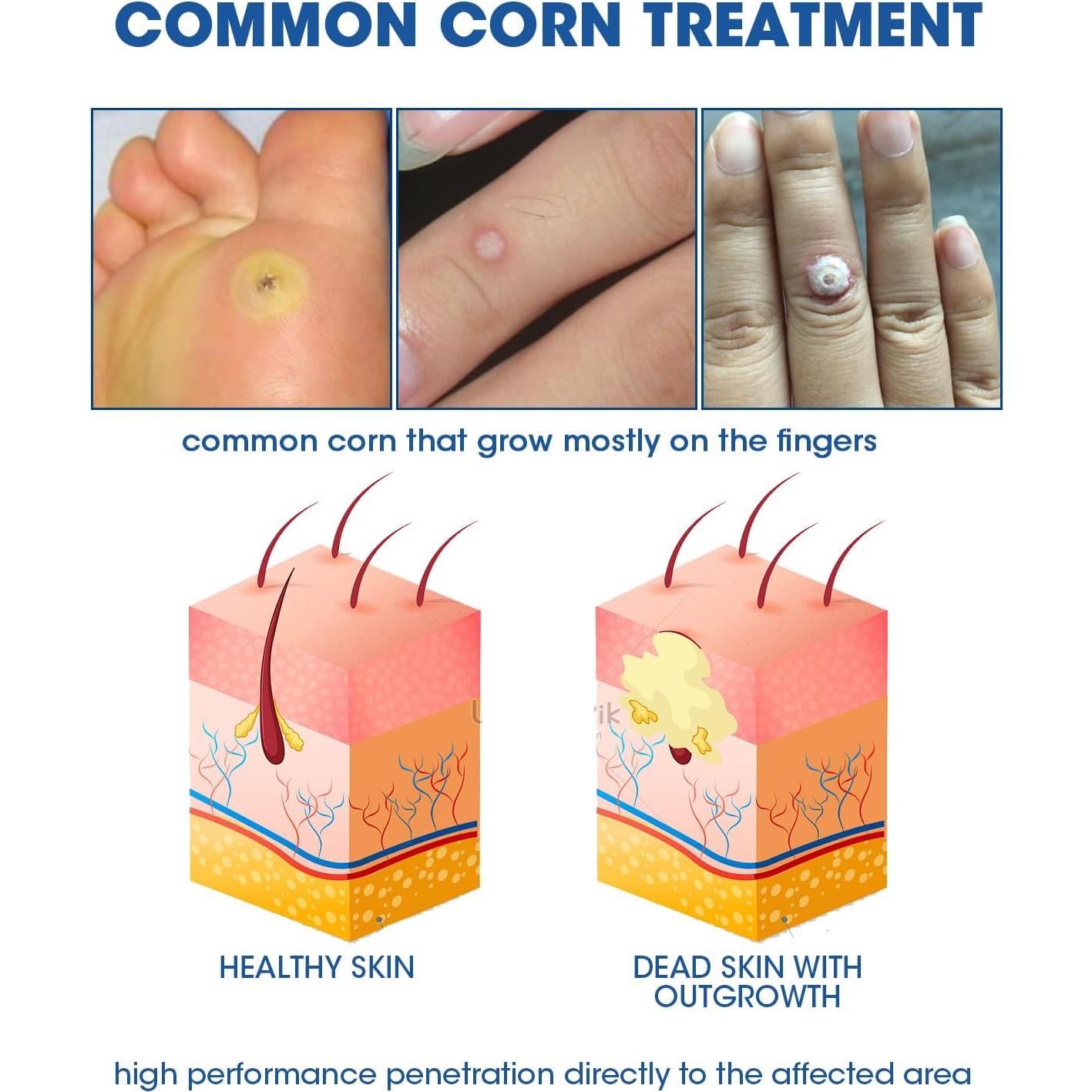 Removedor de Maíz Líquido MYMULIKE 15ml con Aplicadores