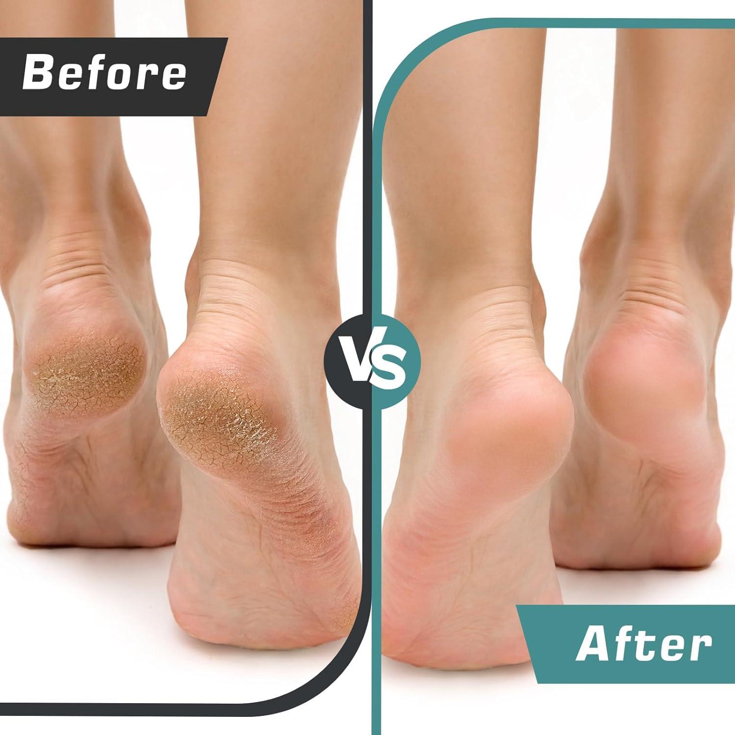 Removedor de Callos Eléctrico EDIFOLLY con 60 Discos de Lijado