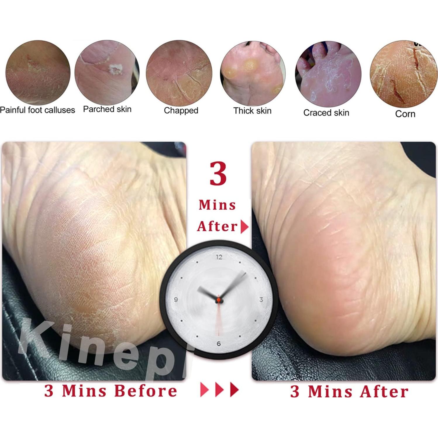 Removedor de Callos Kinepi en Forma de U - Exfoliador de Pies