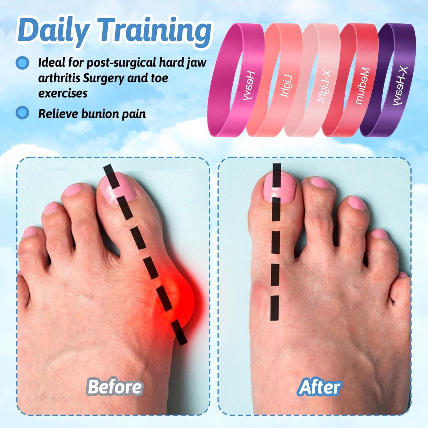 Bandas de Separación para Dedos HekouJiub - 5 Piezas Rosa