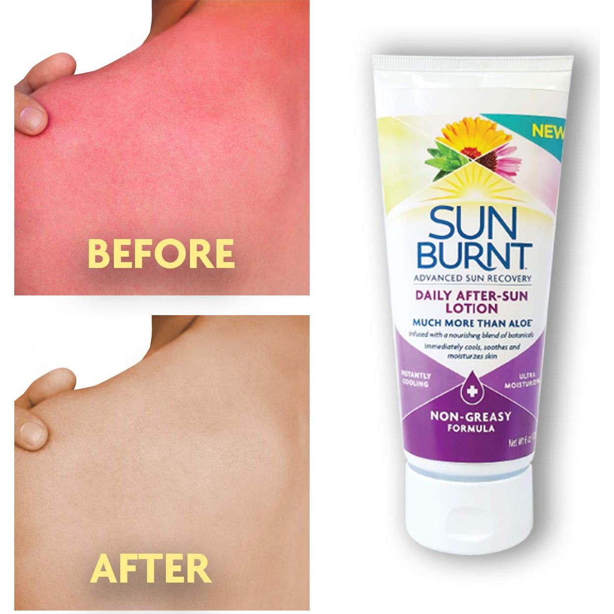 Loción Después del Sol SunBurnt 170g - Hidratante Calmante