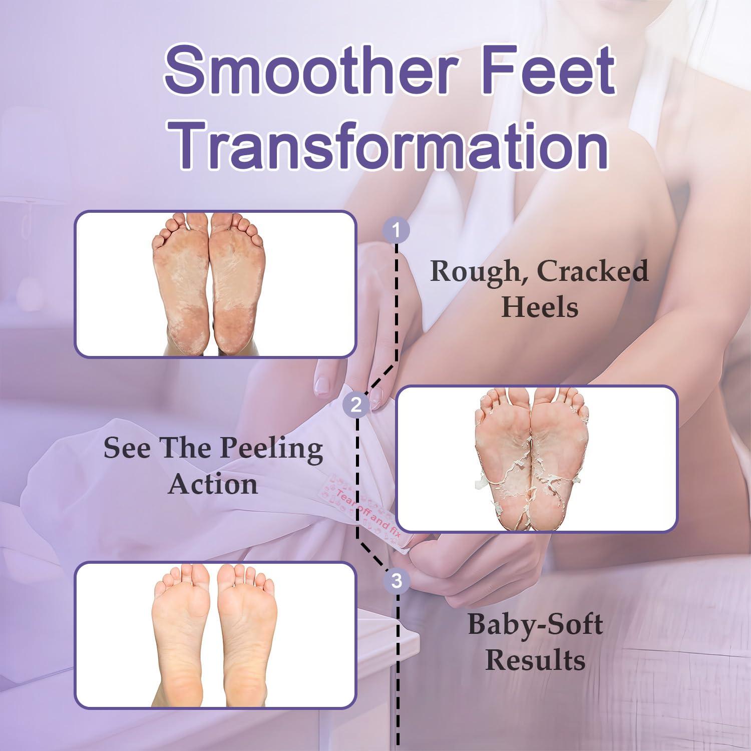 Mascarilla Exfoliante para Pies Genérico - 5 Paquetes con Urea y Lavanda