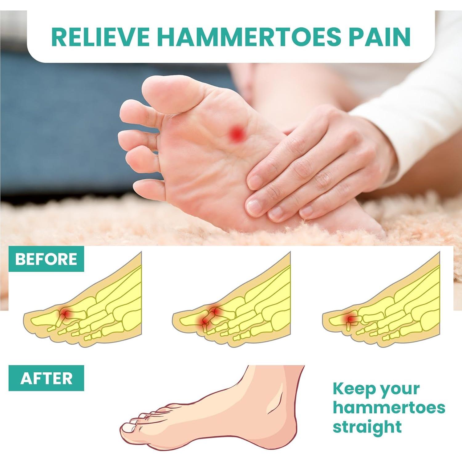 Corrector de Dedos en Martillo Welnove - 8 Piezas Gel Silicona