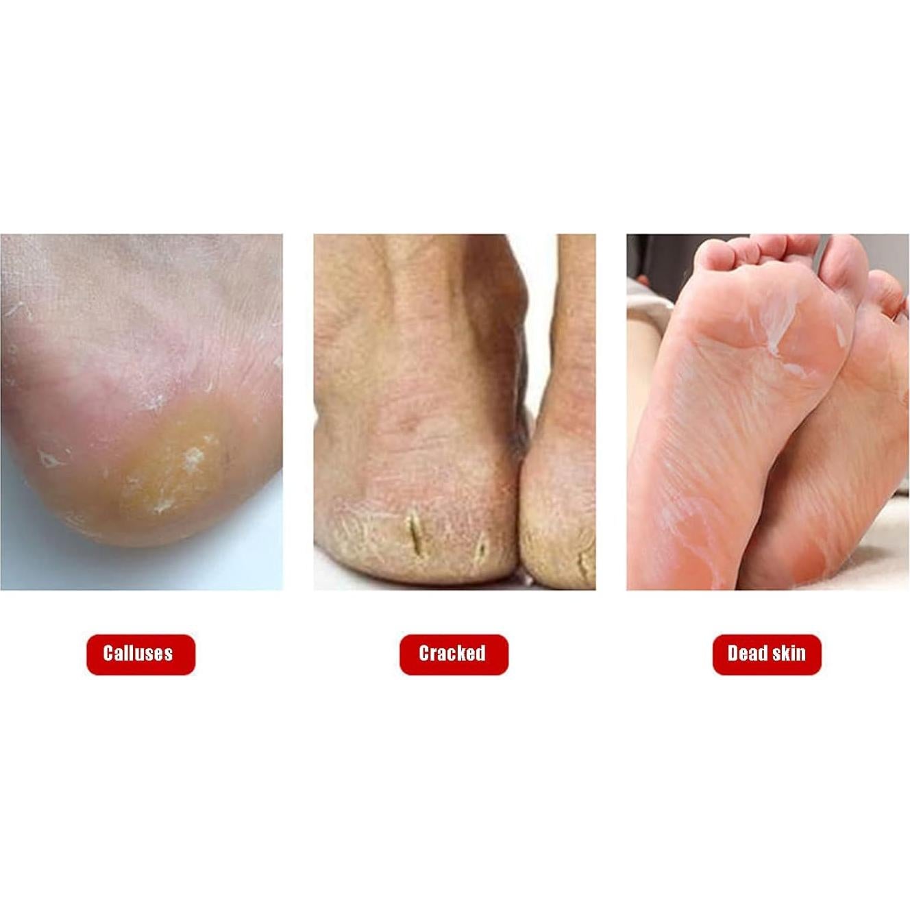 Kit de Lima para Pies Dioche con 11 Cuchillas Exfoliantes