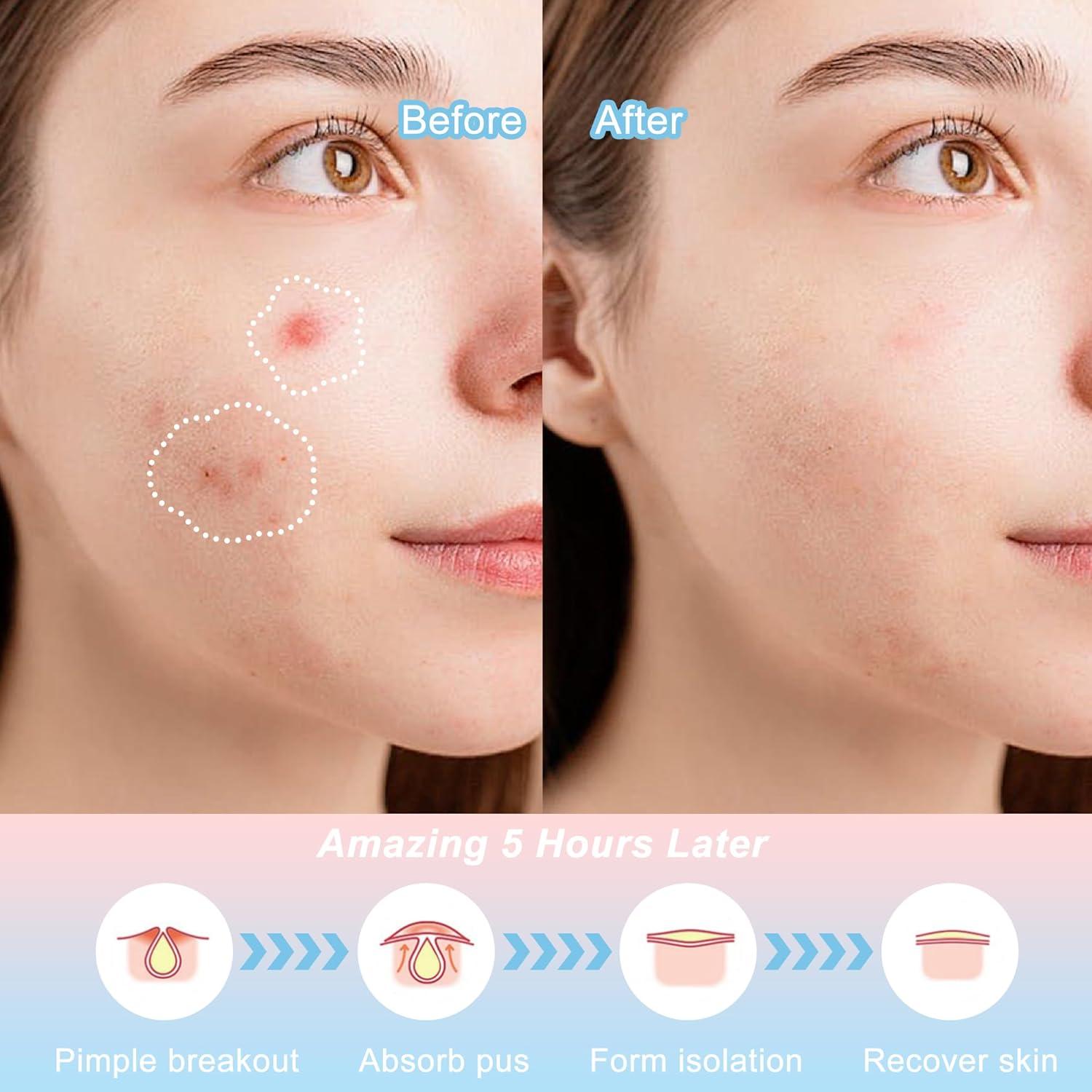 Parches para Acné CELECARE - 148 Unidades con Ácido Salicílico