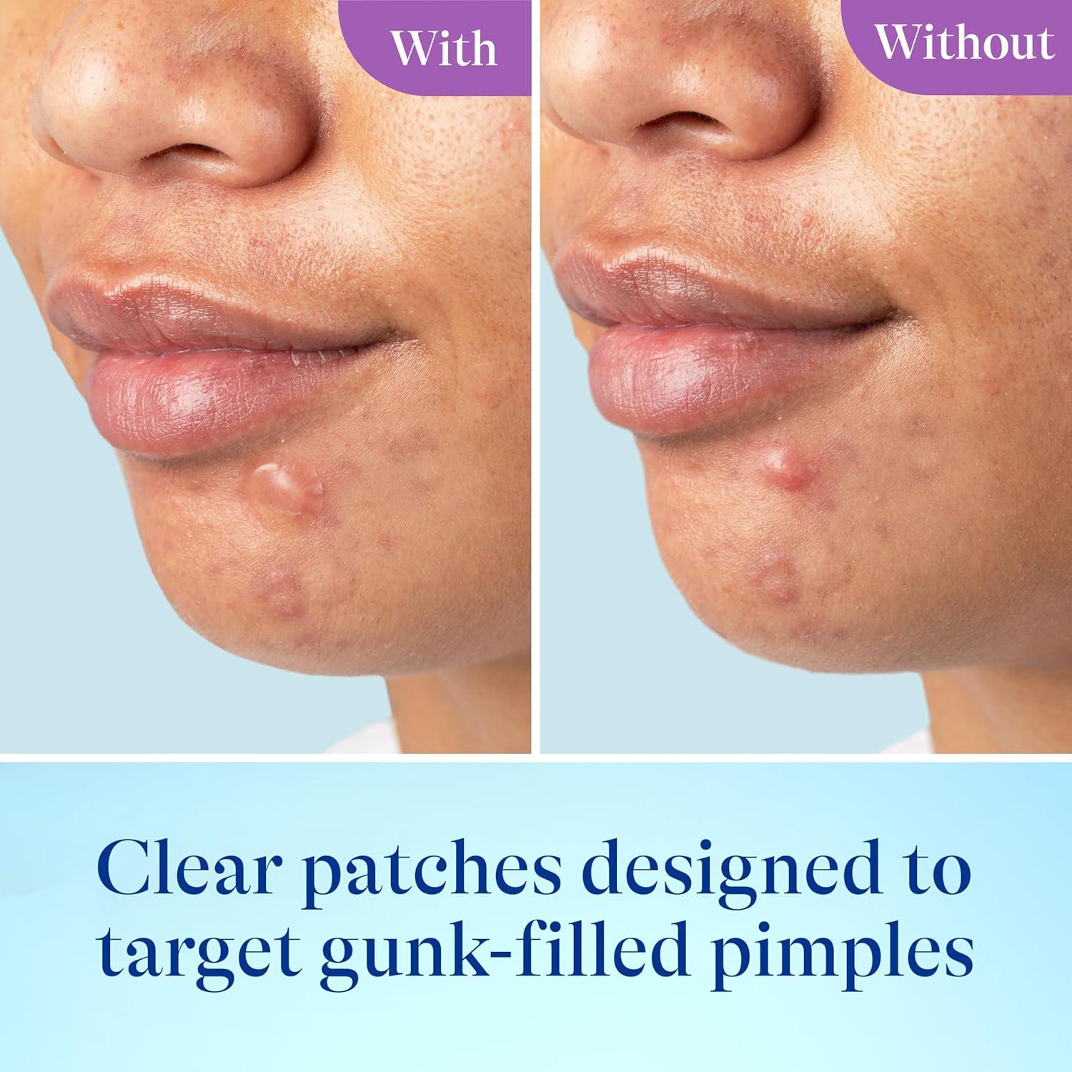 Parches Hidrocoloides Differin para Espinillas 23 ct - Zinc y Niacinamida