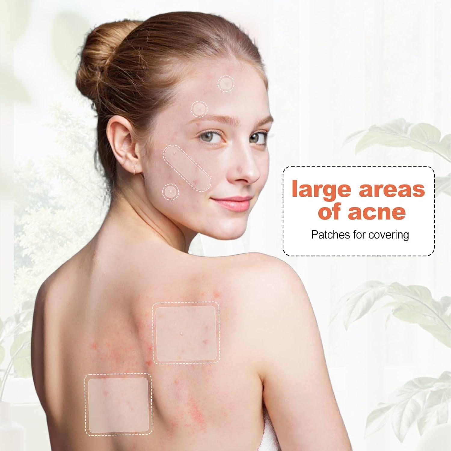 Parche Hidrocoloide para Acné Cabiuty - 68 Parches de 3 Tamaños