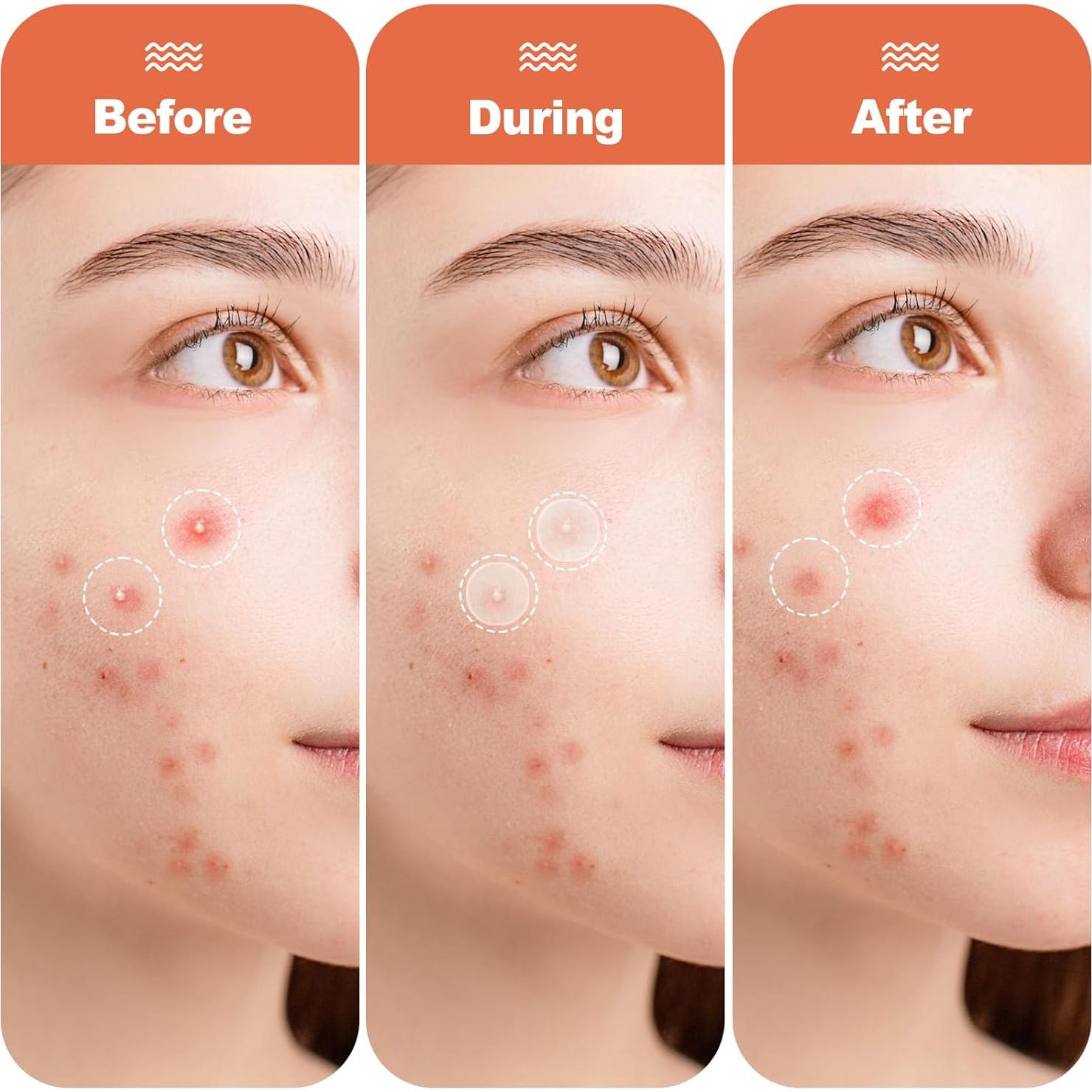 Parche Hidrocoloide para Acné Cabiuty - 68 Parches de 3 Tamaños