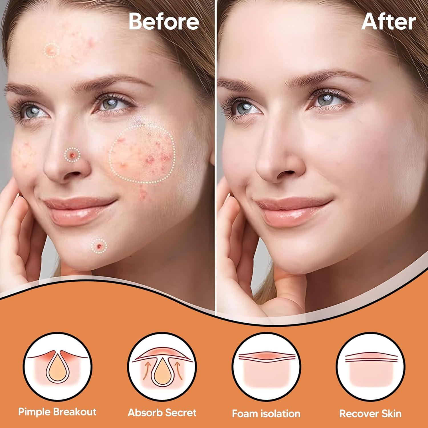 Parche de Acné Hidrocoloide BitMark - 42 Unidades con Espejo