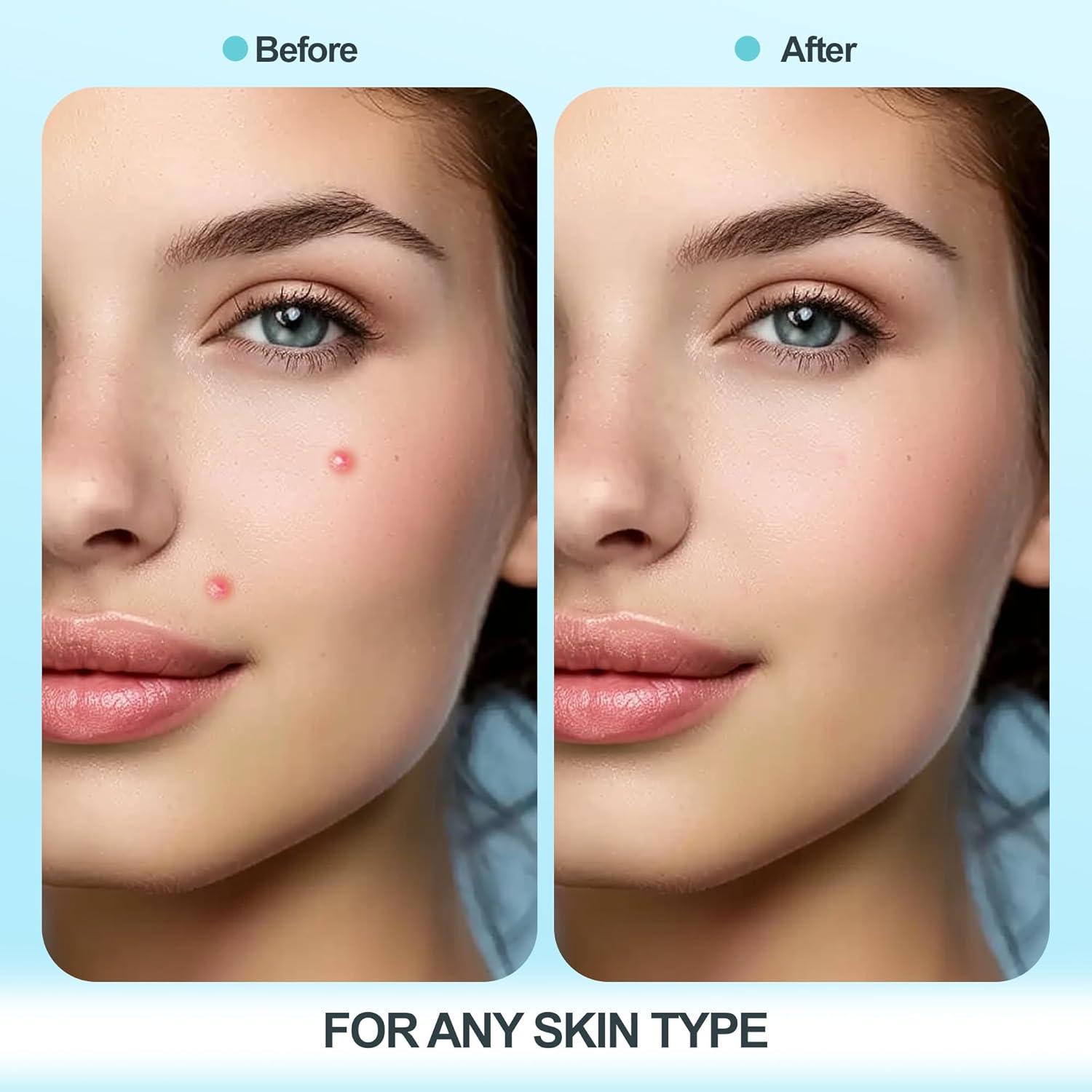 Parche Hidrocoloide para Granos Livaclean 330 Unidades