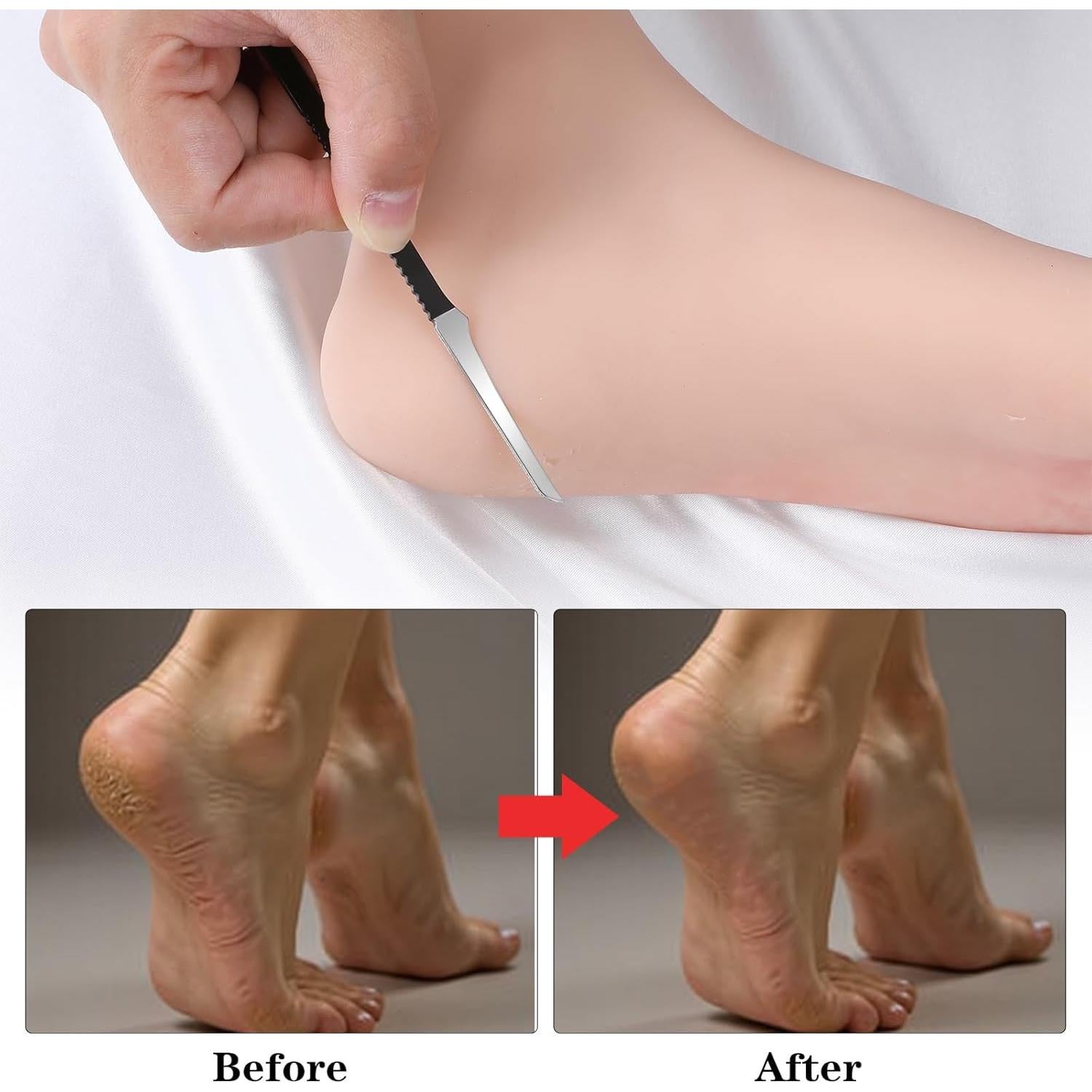 Kit de Remoción de Uñas Encarnadas MBAIYO 6 Piezas Acero Inoxidable