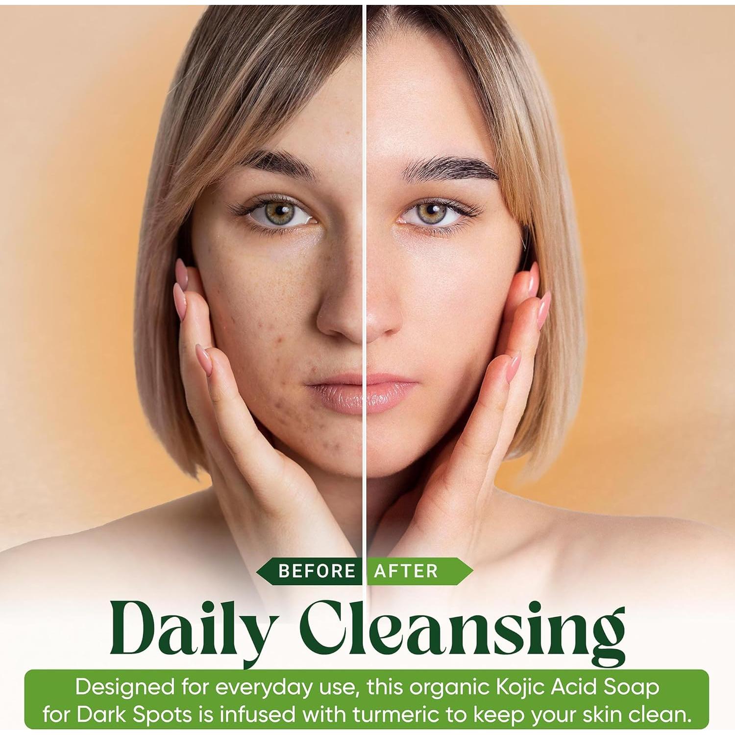 Jabón Ácido Kójico con Cúrcuma AMVital - 2 Barras 99g