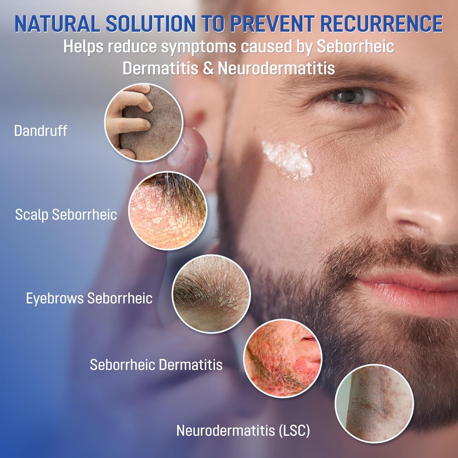 Crema Alivio Dermatitis Seborreica ABERA 30 ml - Peptizinc