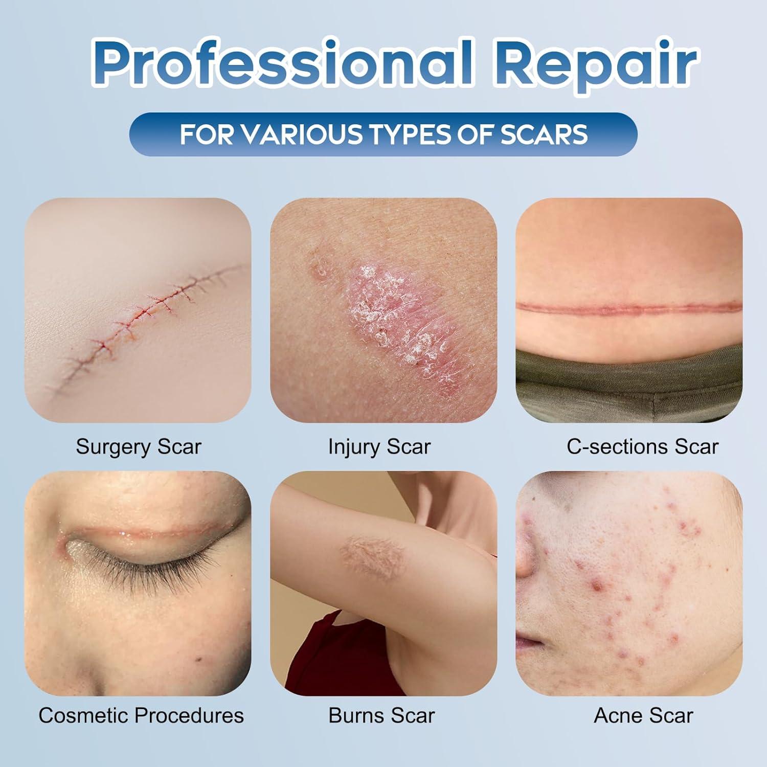 Gel de Silicona Glowor para Cicatrices 49.87g - Acné, Quemaduras