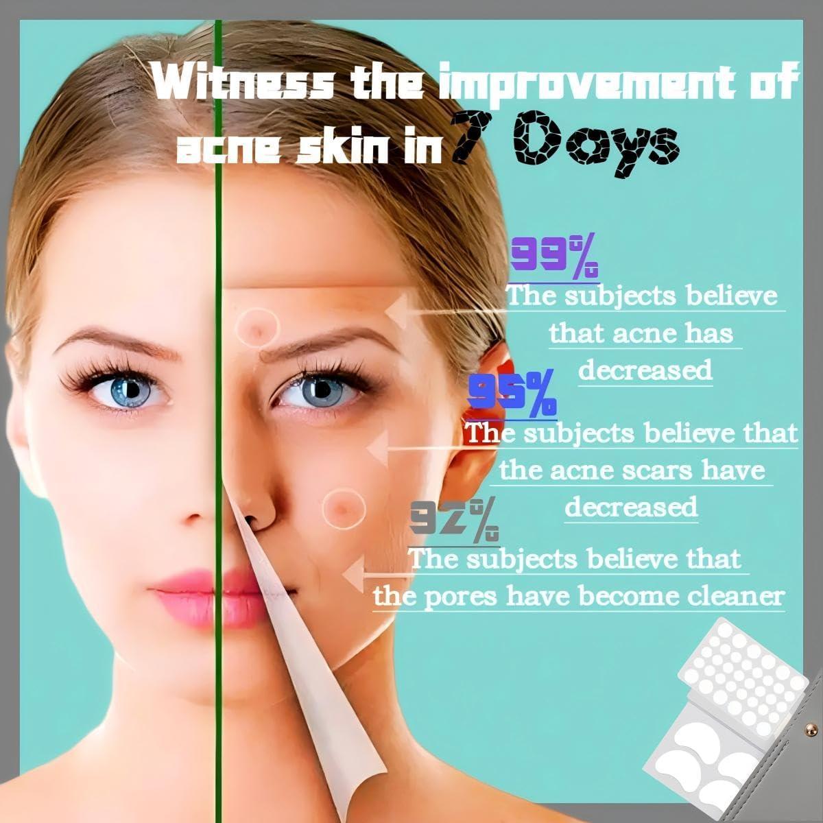 Parche de Acné Hidrocoloide Guiyal - 7 Piezas Grande