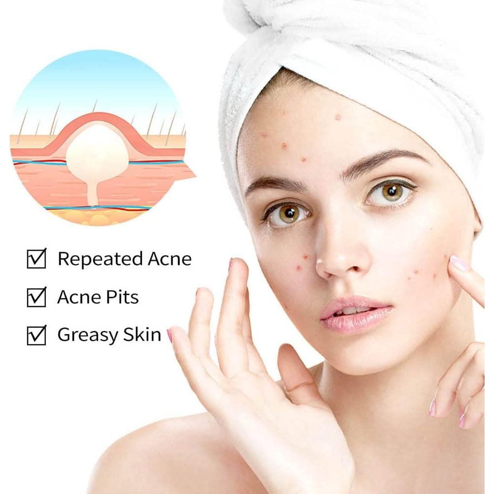 Crema para el Acné Onkessy 15 ml - Control de Aceite y Espinillas