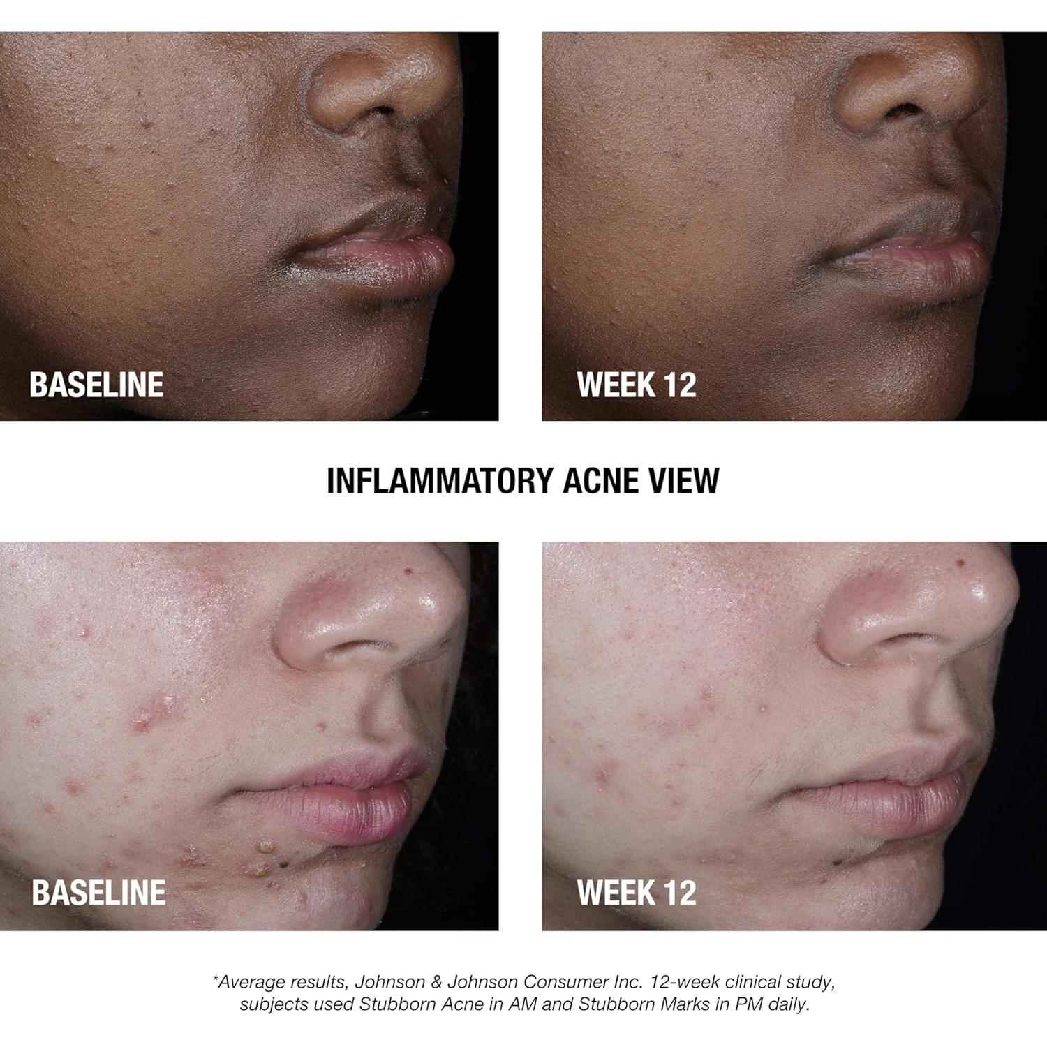 Tratamiento Facial Neutrogena Acné Persistente AM 56.7g 2.5% Peróxido