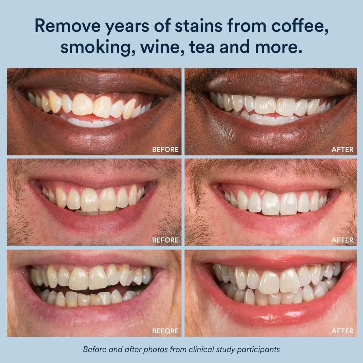 Kit de Blanqueamiento Dental Auraglow LED + Gel 44%