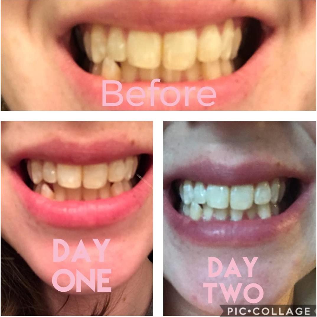 Kit de Blanqueamiento Dental Smile Titan con Luz LED - 5 Piezas