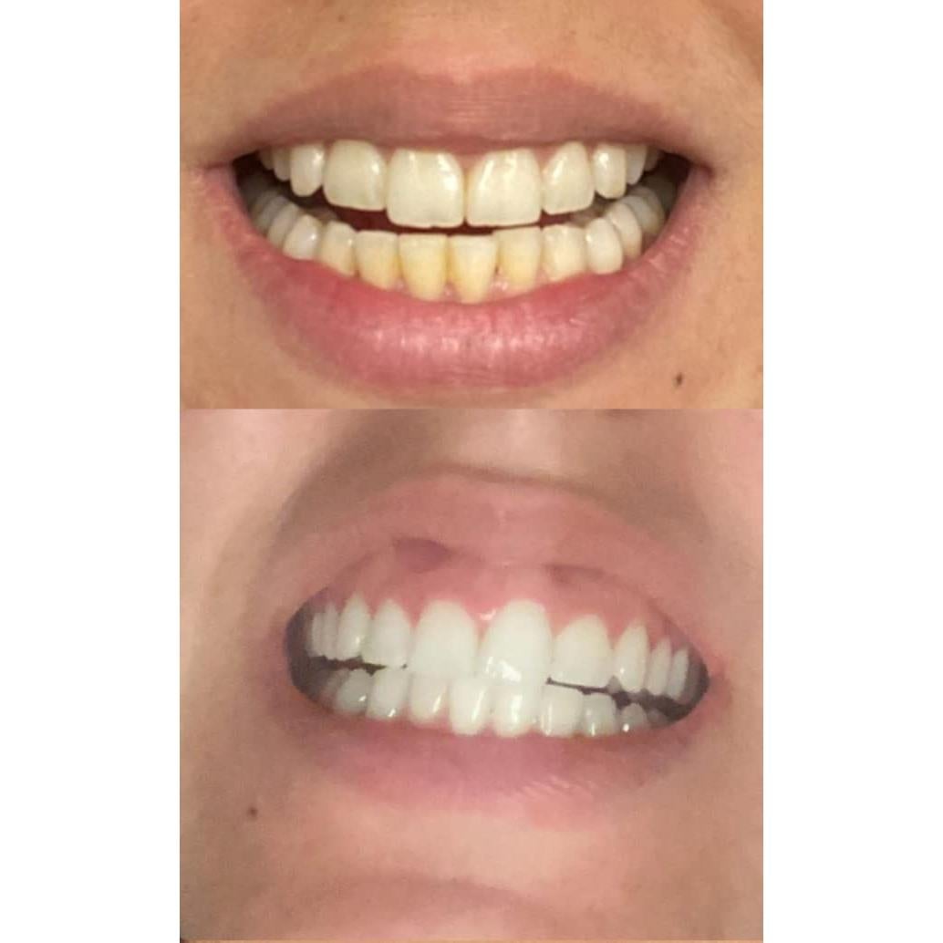 Kit de Blanqueamiento Dental Smile Titan con Luz LED - 5 Piezas