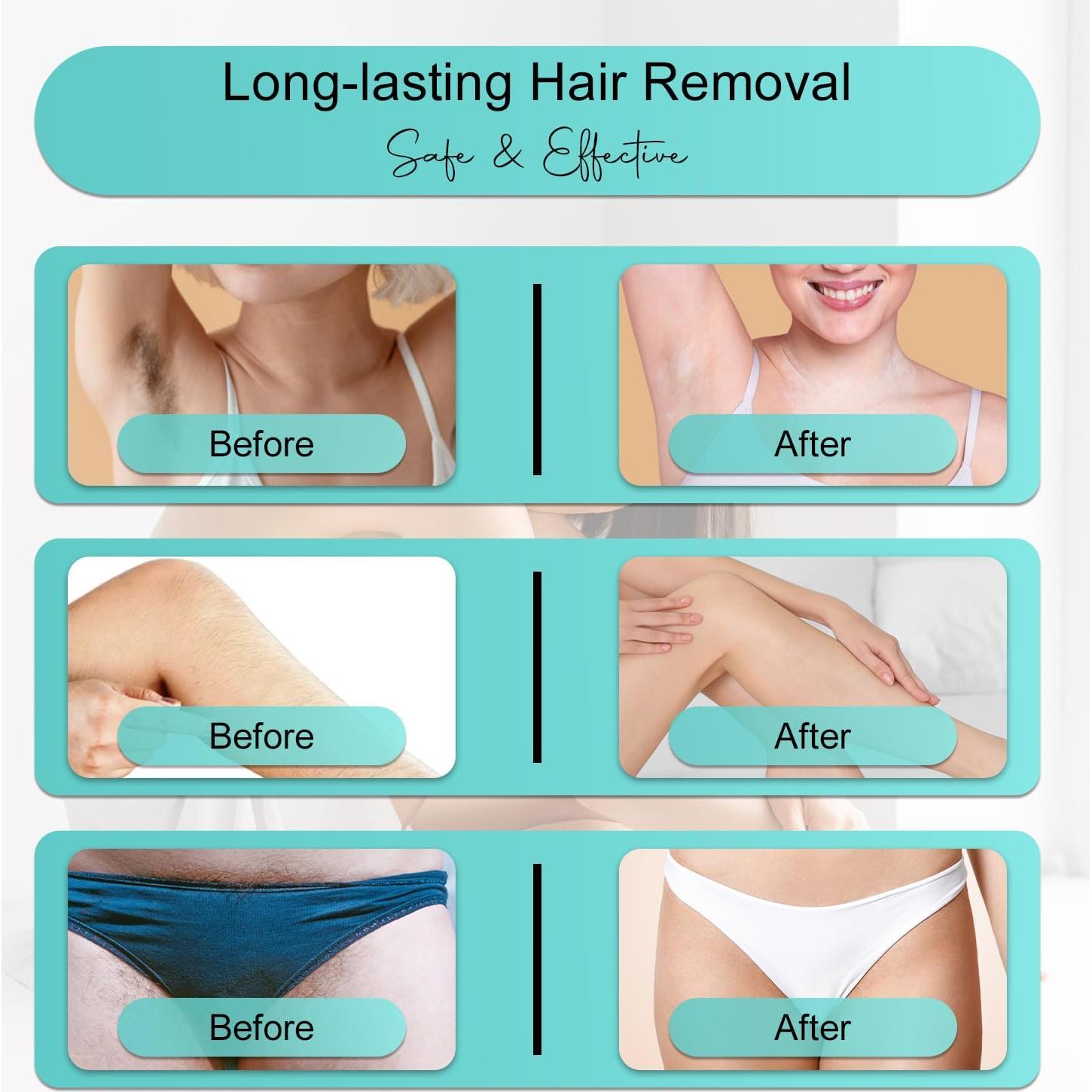 Depilador Láser IPL Semlamp 999,999 Destellos para Todo el Cuerpo