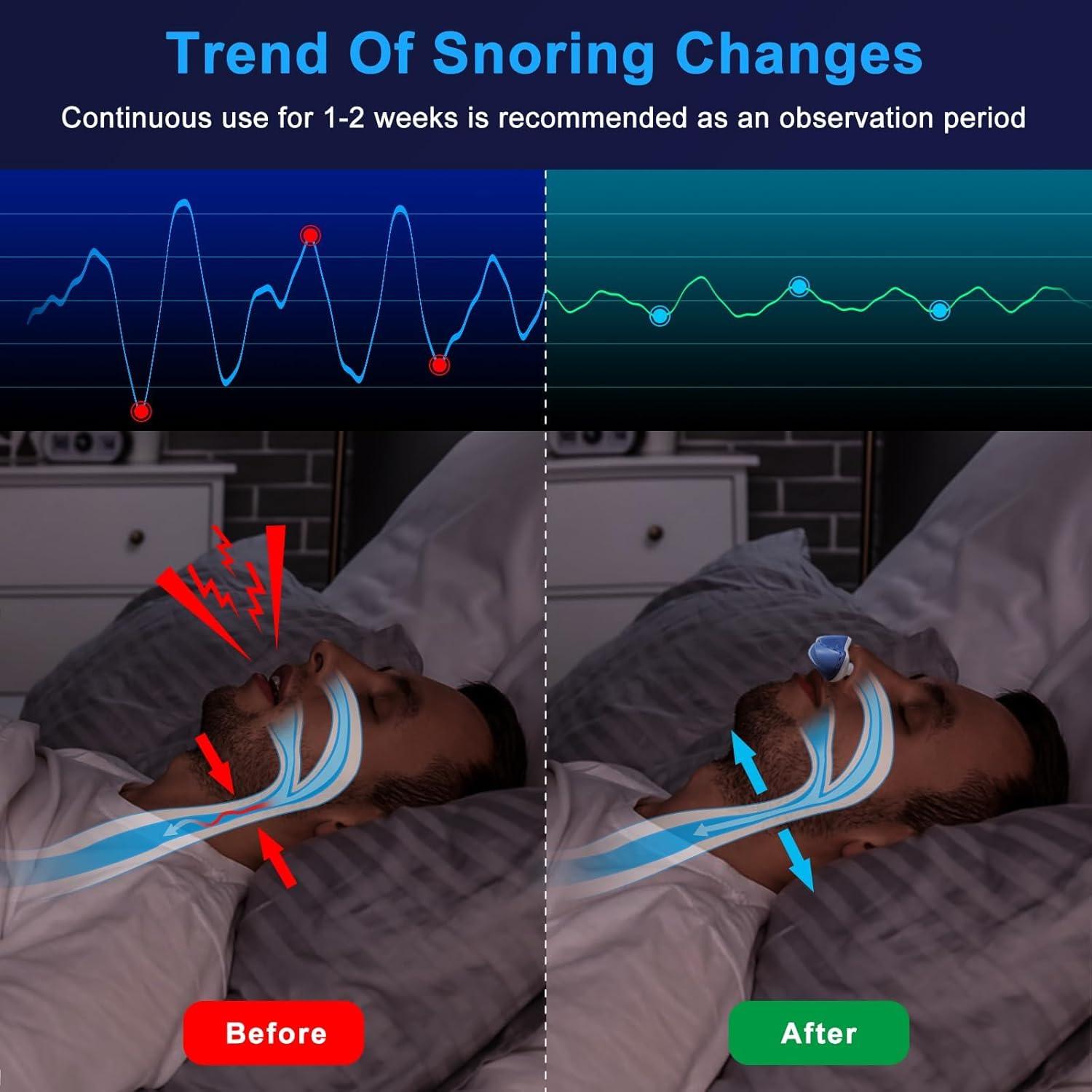 Dispositivo Antisnoring LUNIA Azul - Solución para Ronquidos