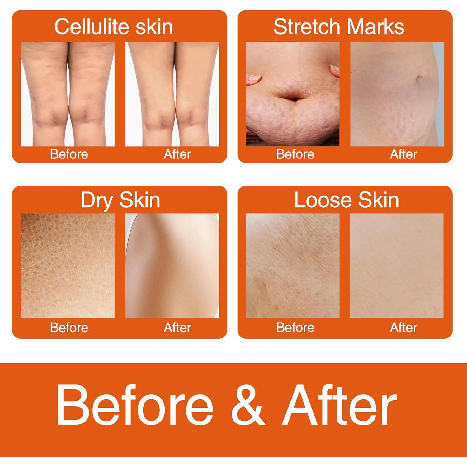 Crema Reafirmante para Celulitis BLININY 100 g - Muslos, Abdomen y Glúteos