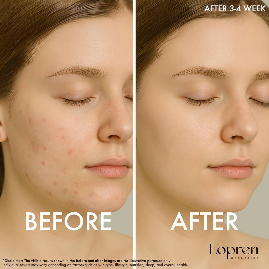 Sérum Exfoliante Facial Lopren AHA 10% BHA 2% 90g