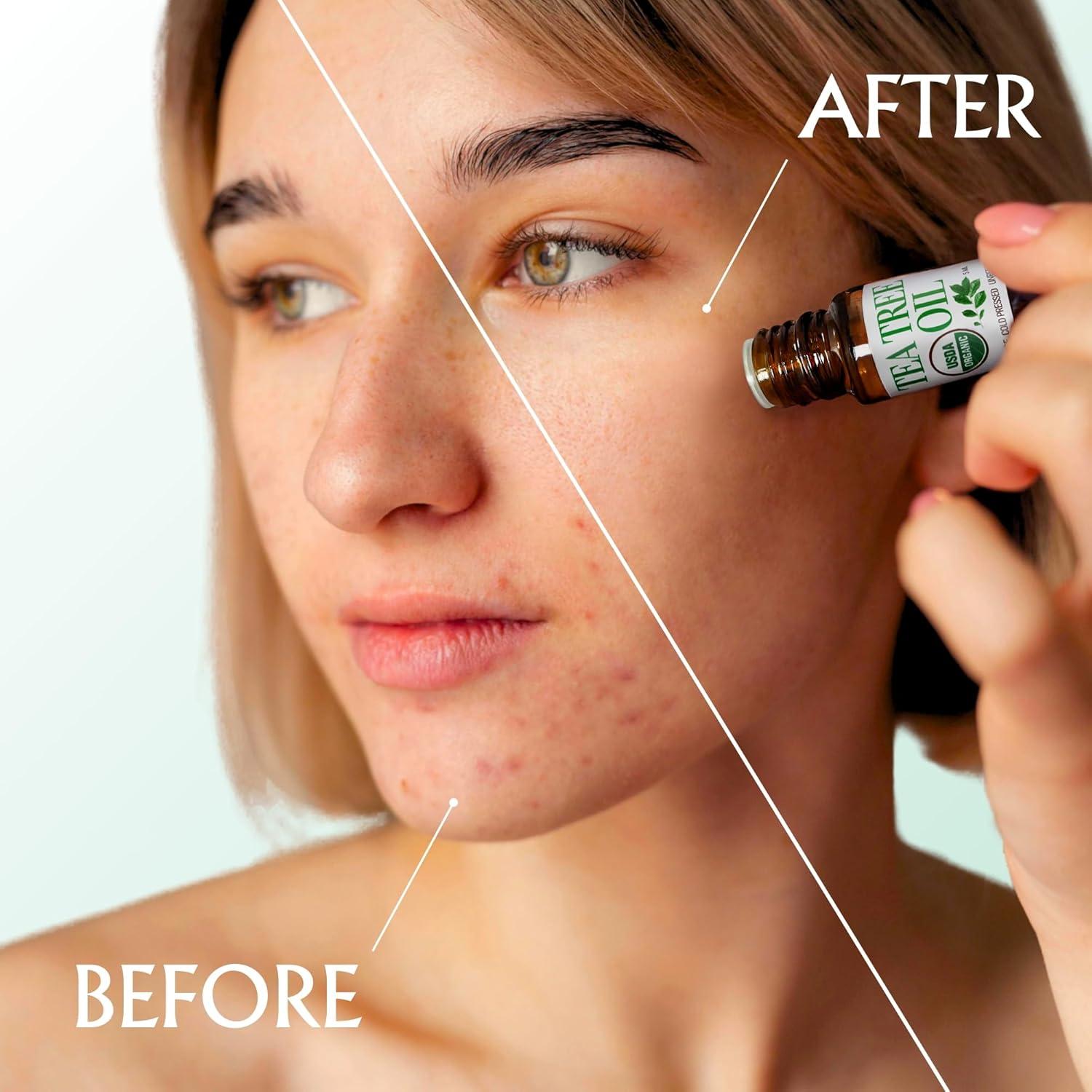 Aceite de Árbol de Té Puro BodyJ4You 5 ml - Orgánico 100% Natural