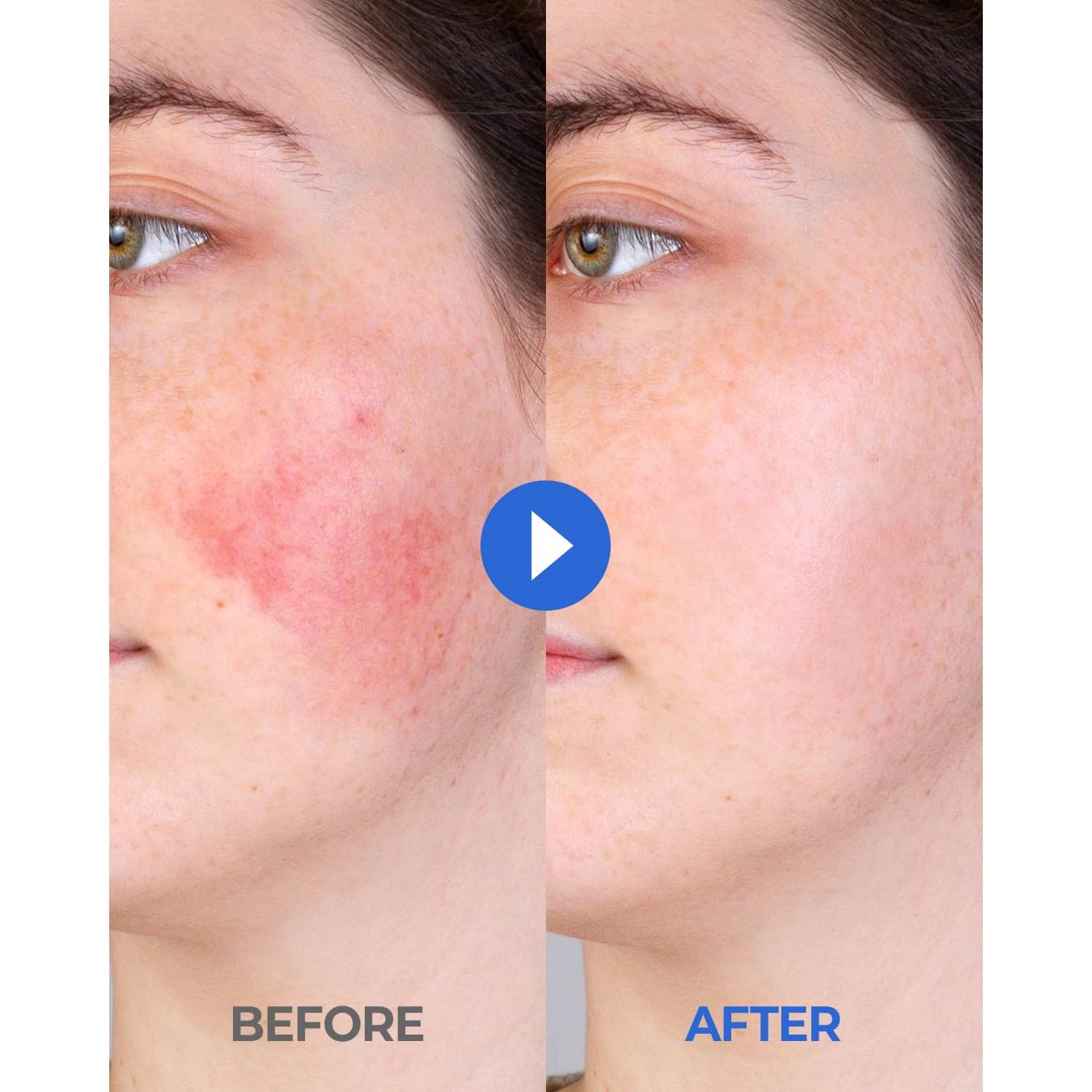 CCP Crema Coreana Hidratante 50 ml Alivio Picazón Piel Seca