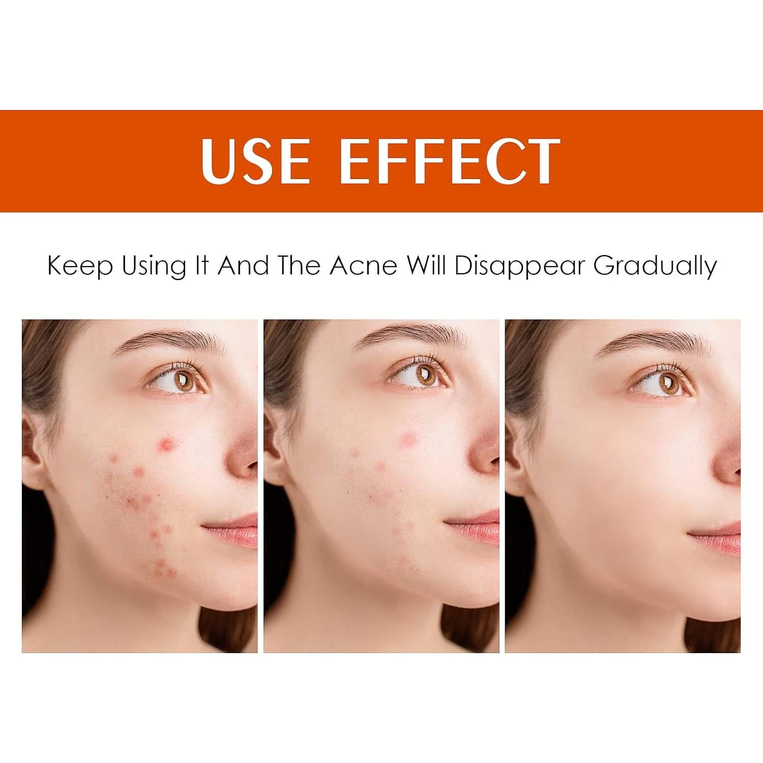 Crema Tratamiento Acné Localizado 30g - Hidratante Anti-acné