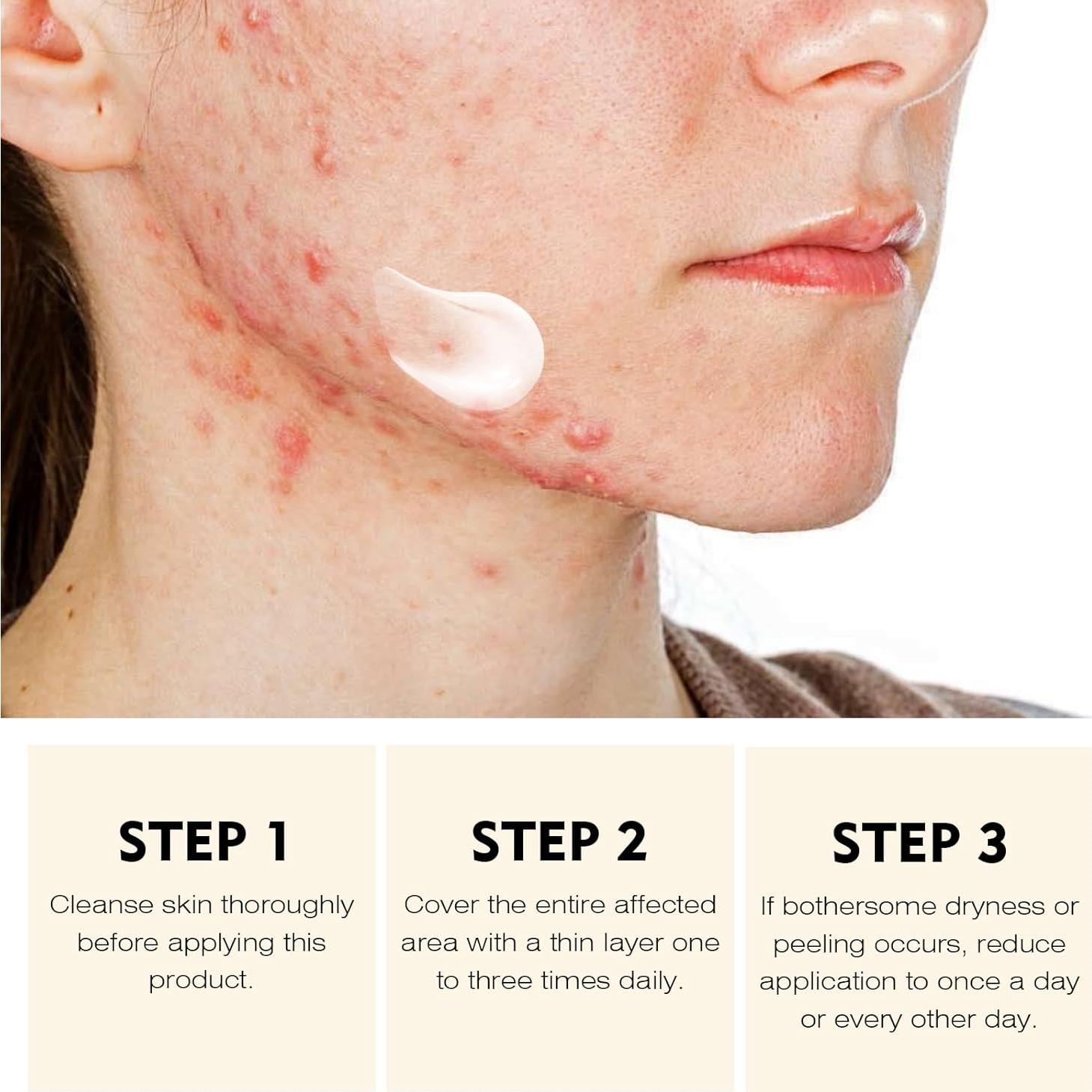 Crema Tratamiento Acné Localizado 30g - Hidratante Anti-acné