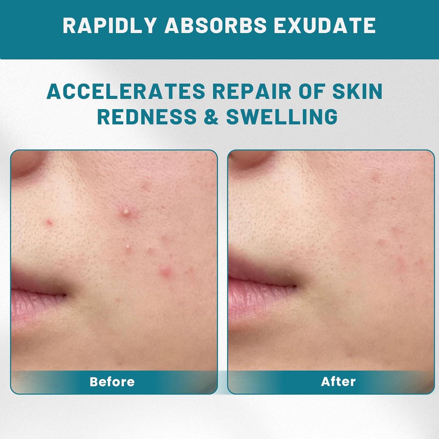 Parches Hidrocoloides para Acné WUYUAN 1.68cm x 19.05cm