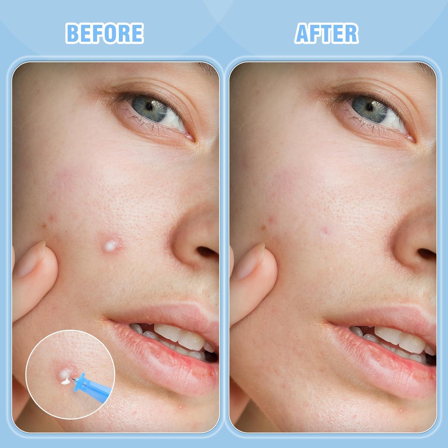 Kit de Remoción de Espinillas AUSLKA - 166 Piezas, Agujas y Parches