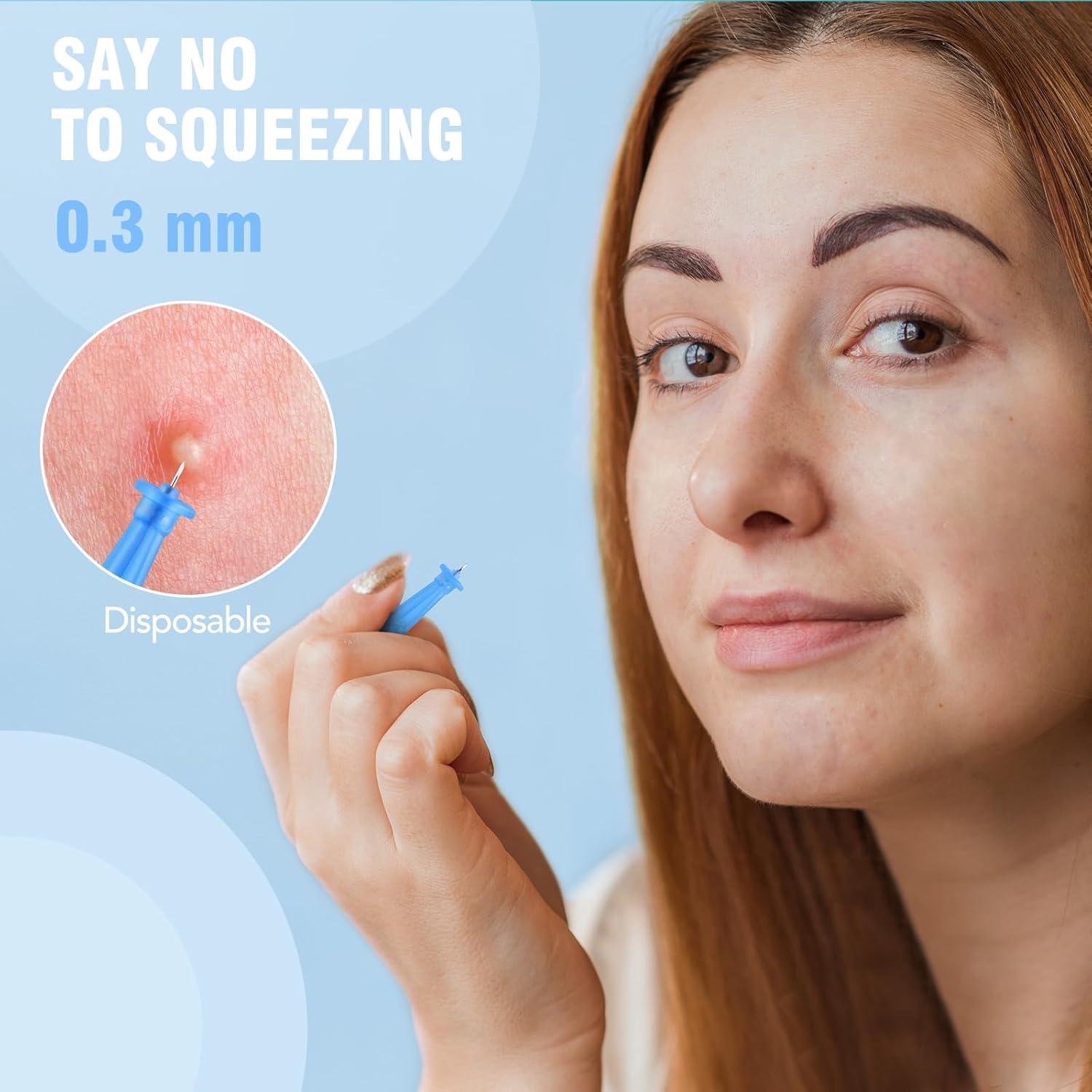 Kit de Remoción de Espinillas AUSLKA - 166 Piezas, Agujas y Parches