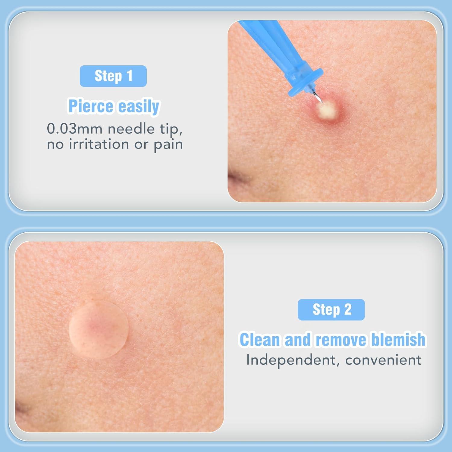 Kit de Remoción de Espinillas AUSLKA - 166 Piezas, Agujas y Parches