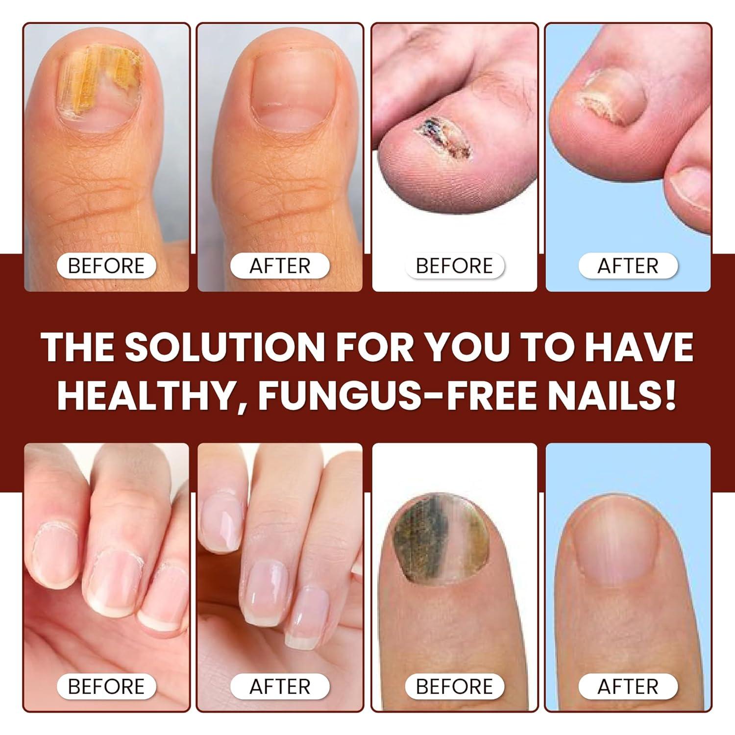 Suero Reparador de Uñas Abera - Cuidado Intensivo Rojo