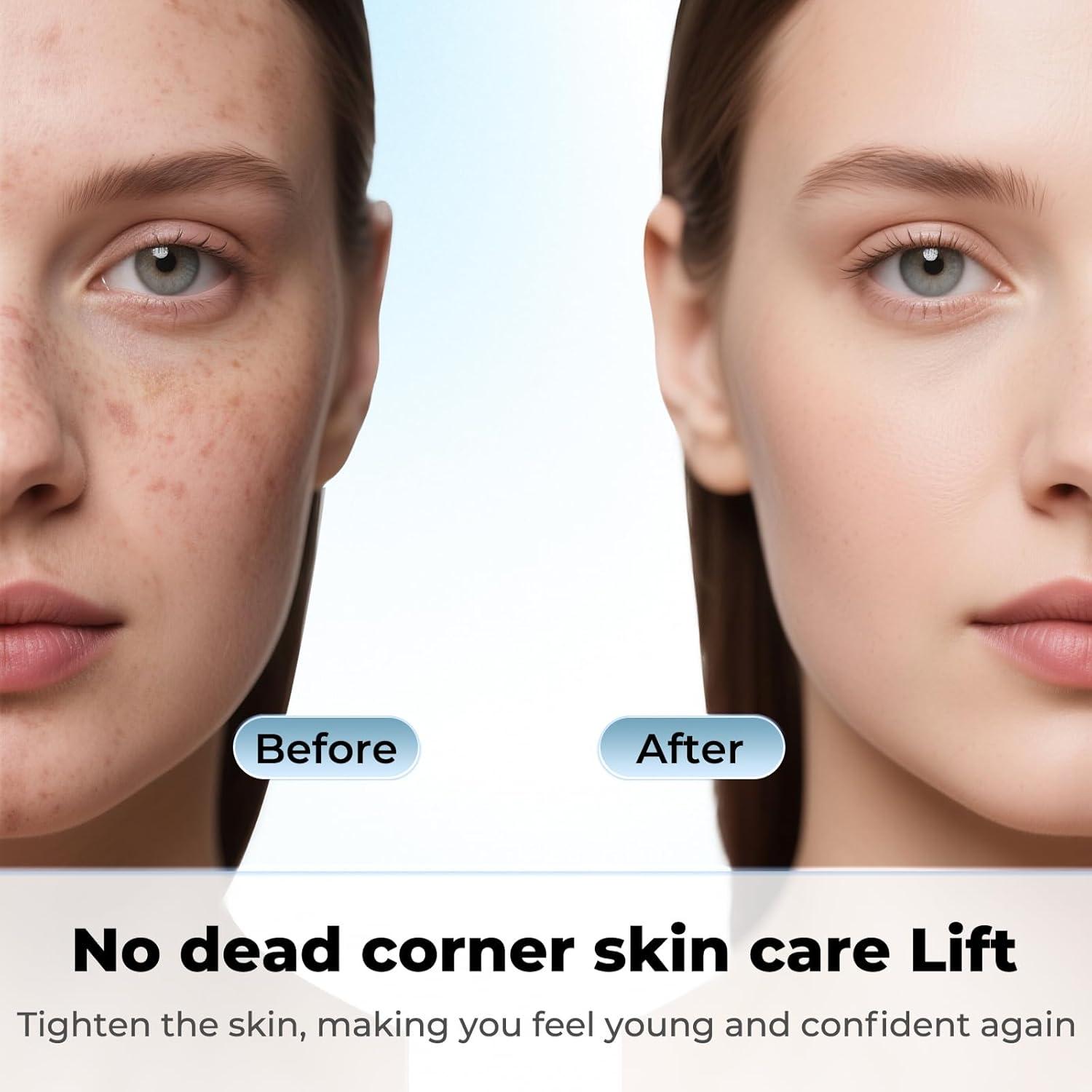 Removedor de Puntos Negros PETYDOOT Doble Cabeza Verde