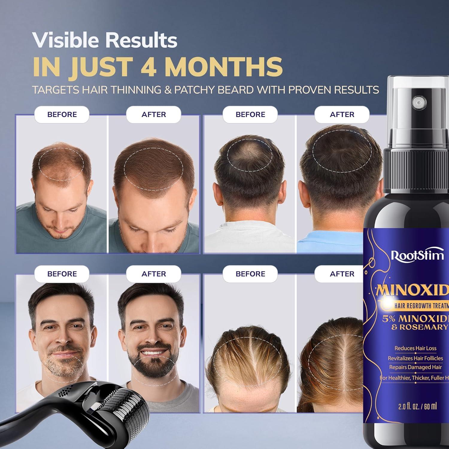 Kit de Minoxidil al 5% RootStim con Rodillo Derma 0.25mm - 60 mL