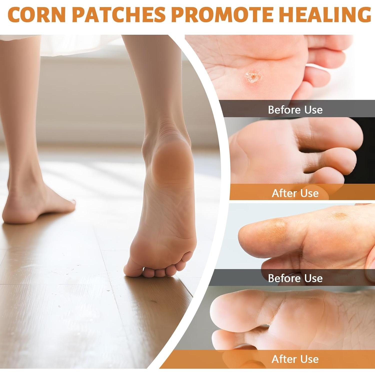 Parches Removedores de Callos AEE - 30 Parches 40% Ácido Salicílico