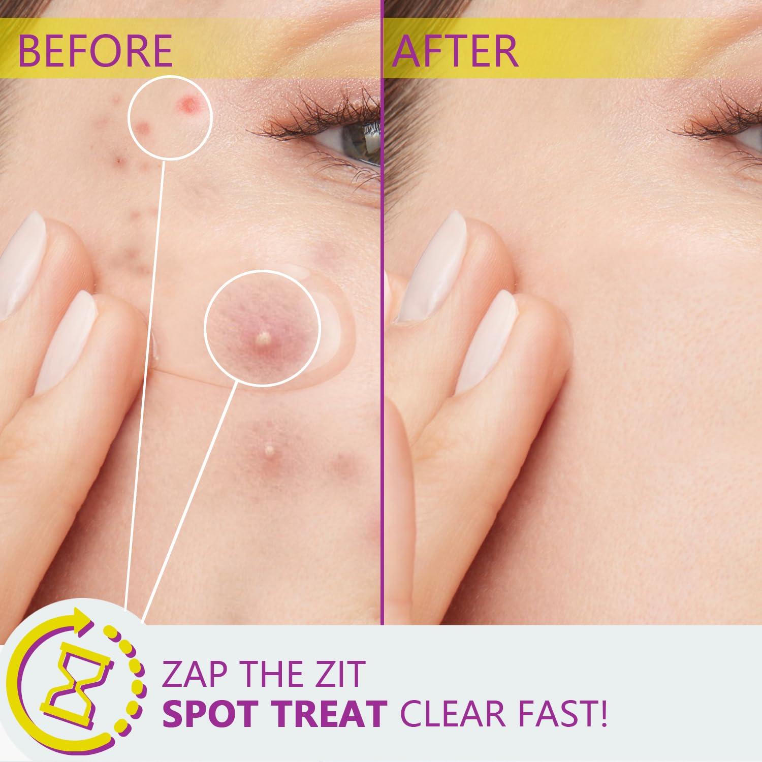 Suero Facial Ácido Azelaico 12% RIGBOO - Niacinamida y Ácido Hialurónico