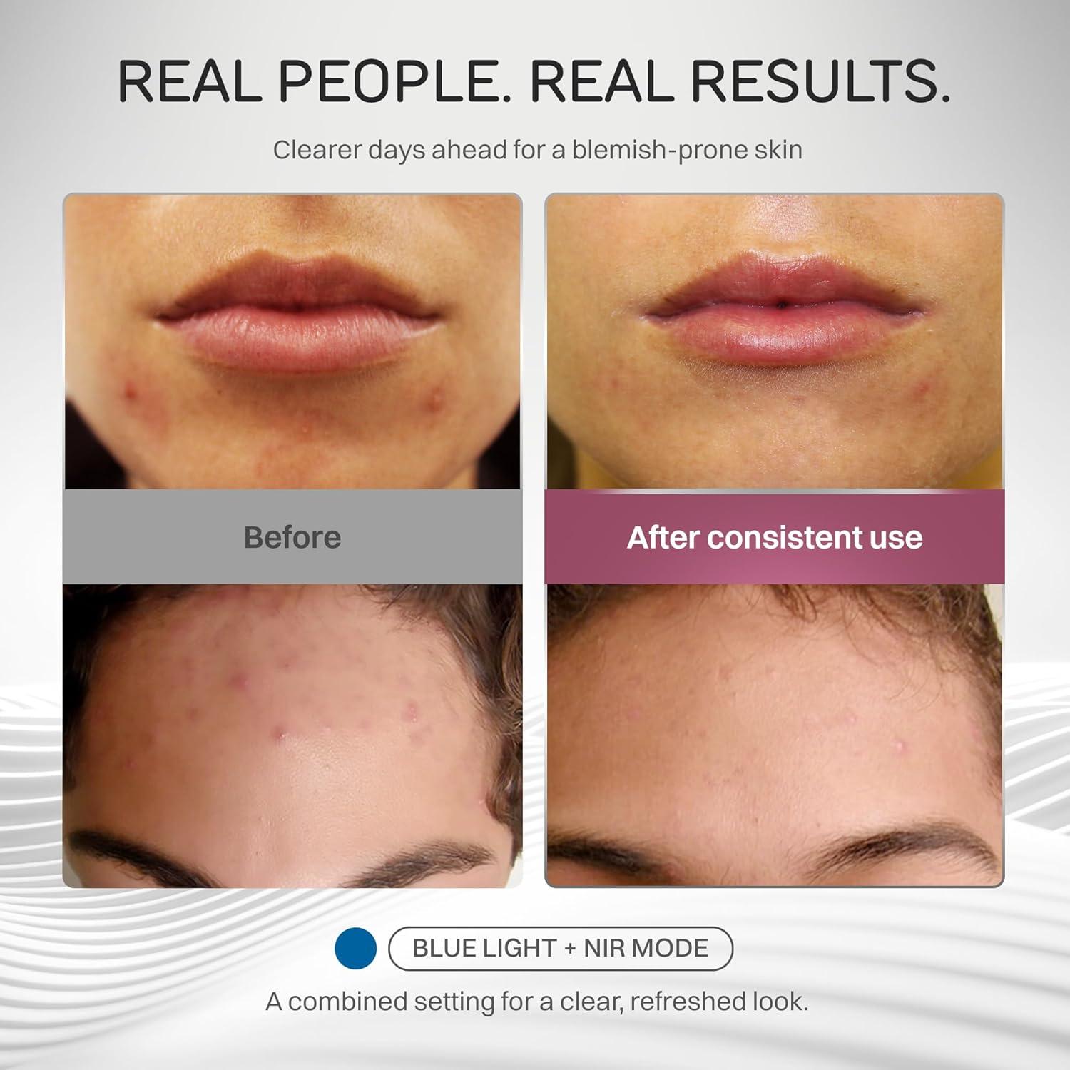 Mascarilla LED Numiere Time Keeper - Cuidado Facial Rojo, Azul y NIR