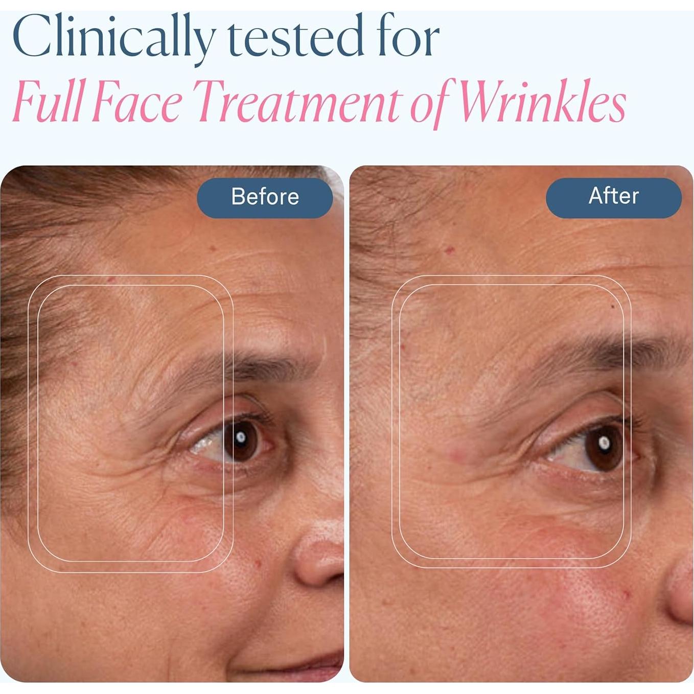 Máscara de Terapia de Luz LED VogueNow - 280 LEDs para Arrugas y Acné