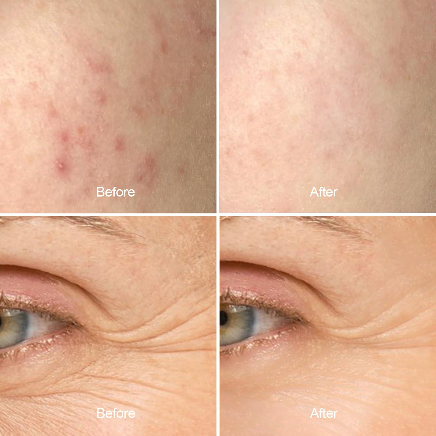 Parche LED Terapia de Luz Roja y Azul Aphrona 7.6x5.8cm